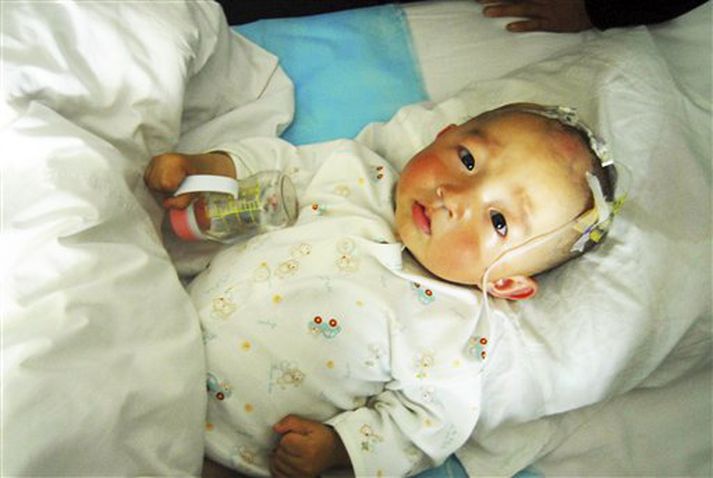 Barn með nýrnasteina fær umönnun á sjúkrahúsi í Kína.